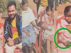 पत्थर शरीर वाली बच्ची के उपचार को लेकर बाल आयोग सक्रिय