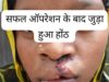 सफल सर्जरी से भीमे हेमला के चेहरे पर लौटी मुस्कान