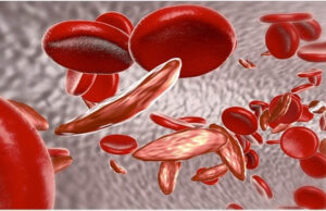Sickle Cell Disease: देश के 59% मरीज ओडिशा और MP में मिले, 7.27 करोड़ लोगों की हुई जांच